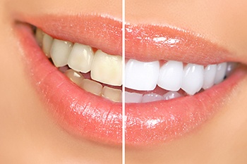 Smile that’s halved to show teeth whitening results