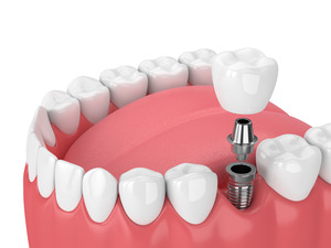 Illustration of dental crown being attached to dental implant