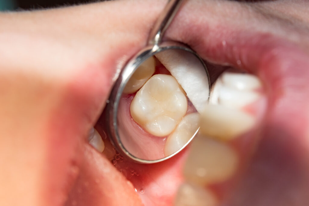 Patient with a new dental crown